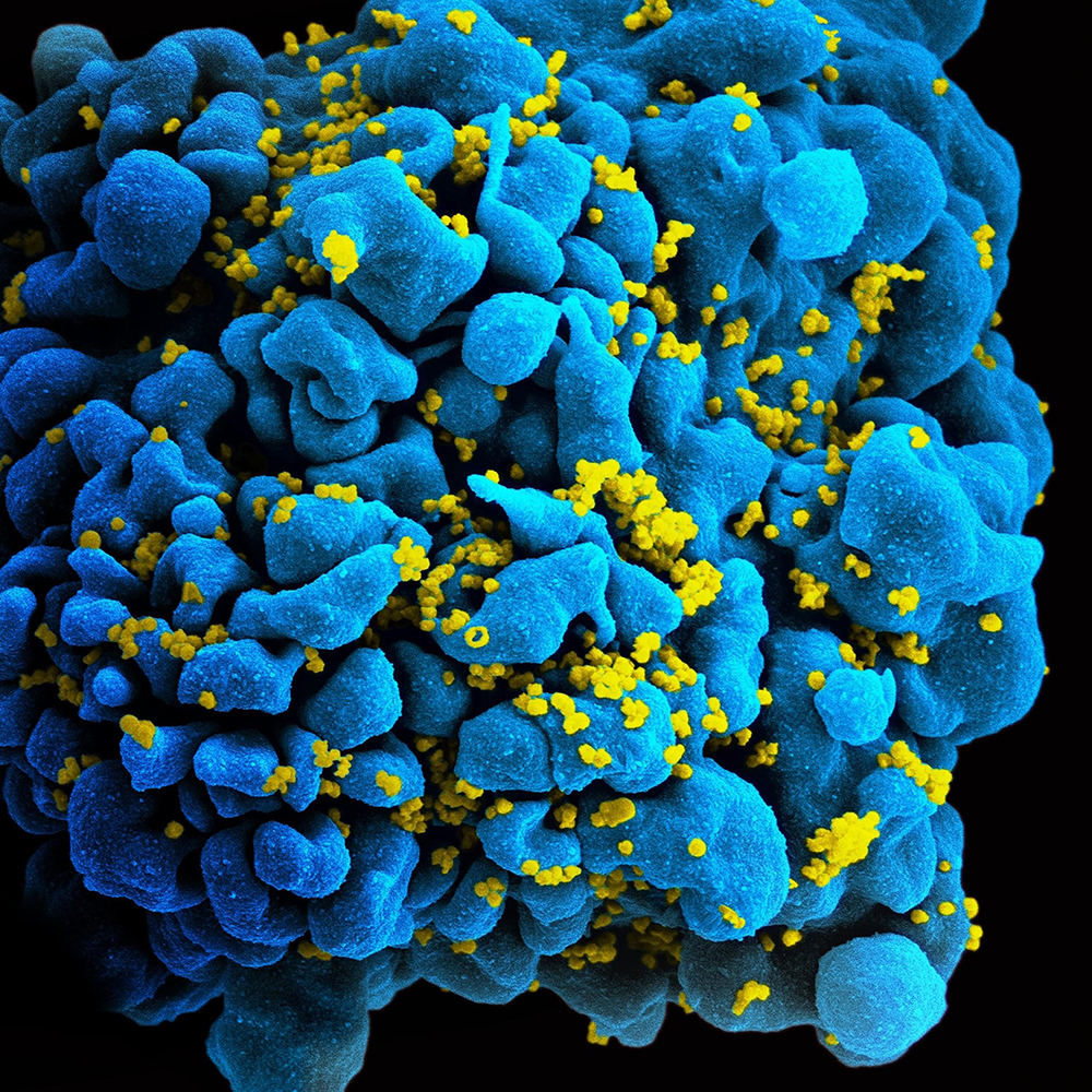 Hidden cell-based HIV reservoirs found via sugar signatures