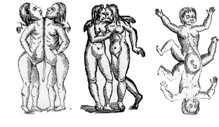 An illustration depicting six of the different conjoined twin possibilities from On Monsters and Marvels by Ambroise Paré. Although our scientific understanding of conjoined twins has advanced significantly since this publication in 1573, the illustrations provide a visual reference for conjoined twins