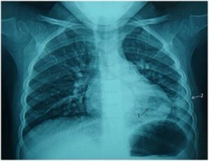 COVID-19 Pneumonia – A Different Illness Than Its Traditional Counterpart