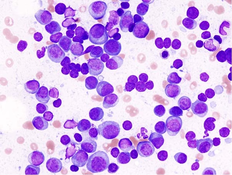 Smear preparation of bone marrow from a patient with multiple myeloma, the cancer of plasma cells