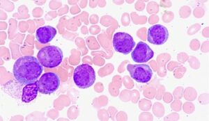 Bispecific Antibody Recruits Vγ9+ γδ T cells for Leukemia Treatment