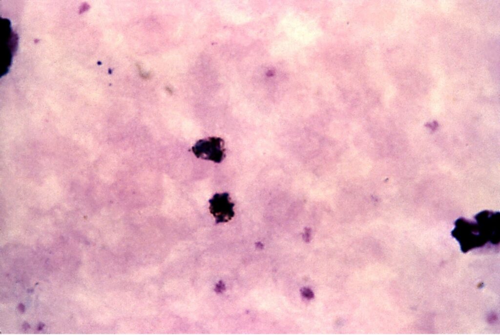 Similar to the images shown to MalariaSpot participants, this image depicts a thick blood smear containing both white blood cells (large, dark purple spots), and malaria parasites (small, purple spots in the upper left-hand corner). The species depicted here are Plasmodium malariae